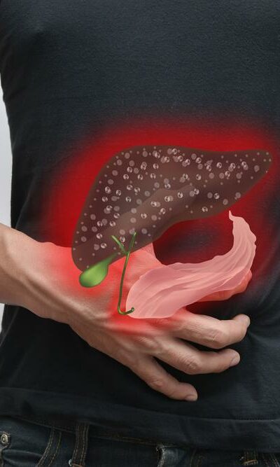 Liver cancer: Causes, symptoms, diagnosis, treatment, and prevention