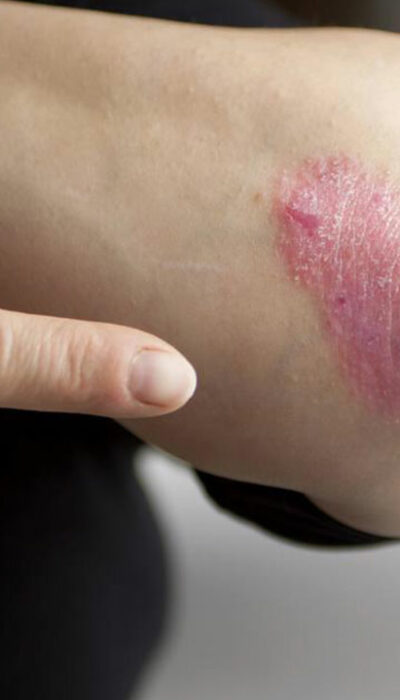 Moderate to severe plaque psoriasis treatment