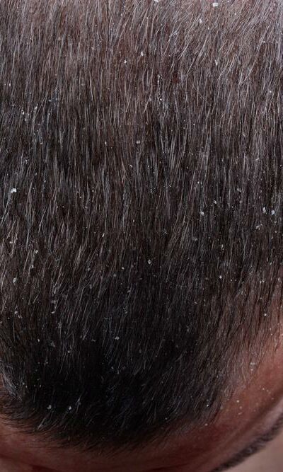 Scalp Psoriasis