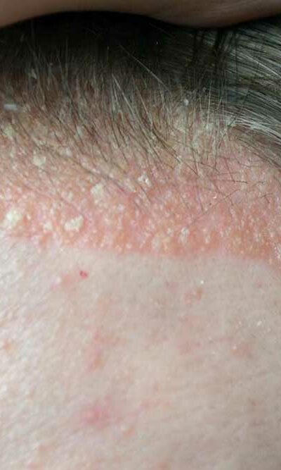 Scalp Psoriasis &#8211; Symptoms to Watch out For