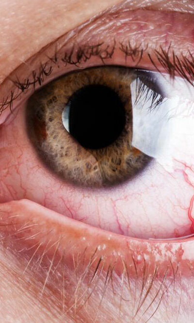 Signs that you might be experiencing dryness of your eyes