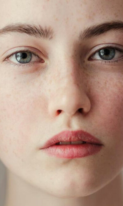 Simple home remedies for freckles