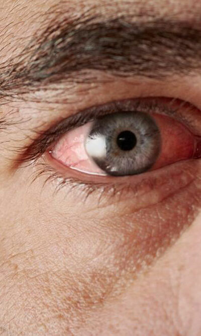 Sjogren&#8217;s Syndrome- Causes and Symptoms