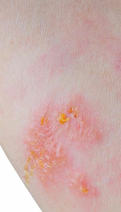 Skin Rash: Which condition is it?