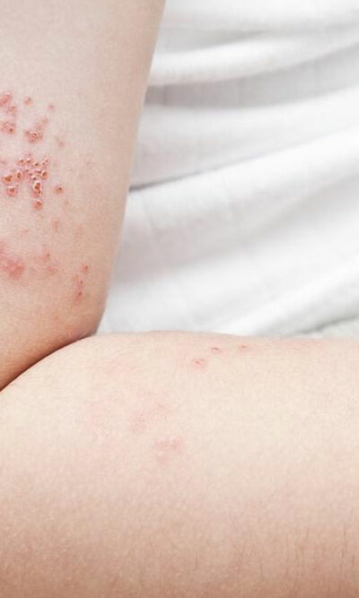 Prevent yourself from shingles before it infects you