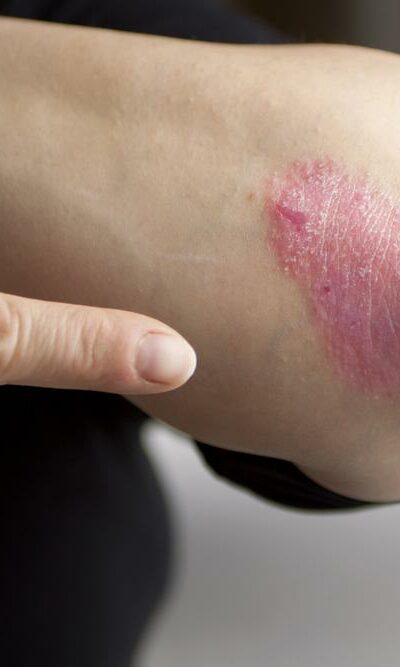 Psoriasis Symptoms