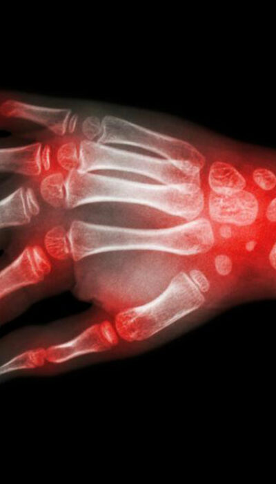 Rheumatoid arthritis and lupus – what makes them similar?