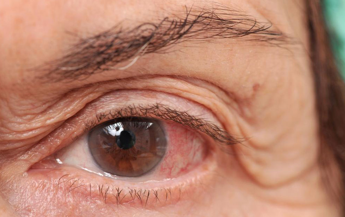 Ways of dealing with chronic dry eye disease