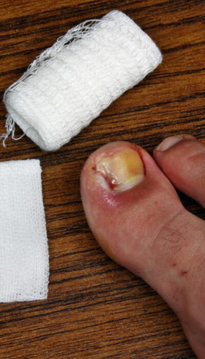 Ways to Treat Toe Nail Fungus During Pregnancy