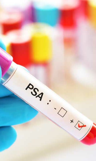 What are the Normal PSA Levels as Per Age