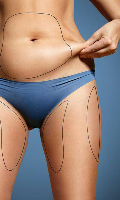 What is coolsculpting fat freezing?