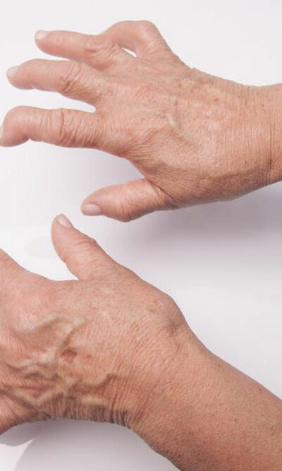 What you need to know about Rheumatoid Arthritis and Lupus