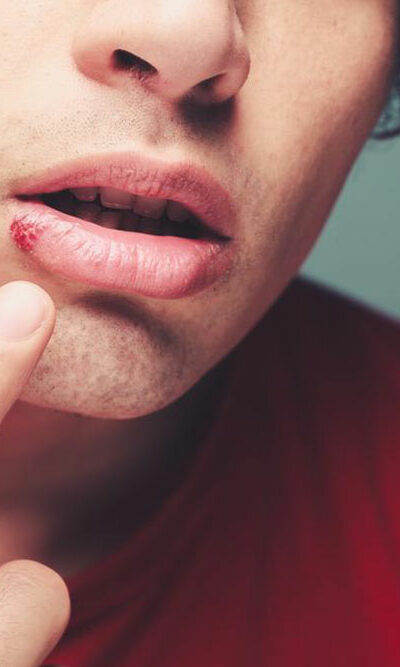 Top 4 FAQs about cold sores