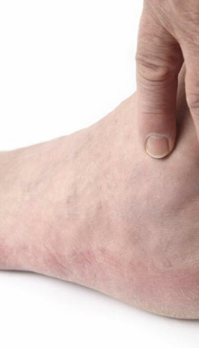 Top Causes of Swollen Ankles