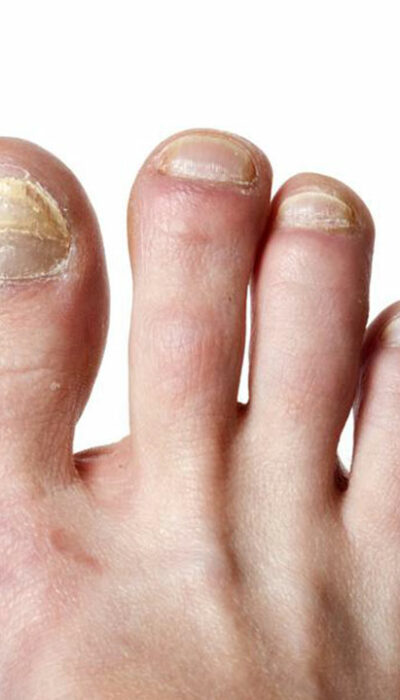 Top signs of toe nail fungus