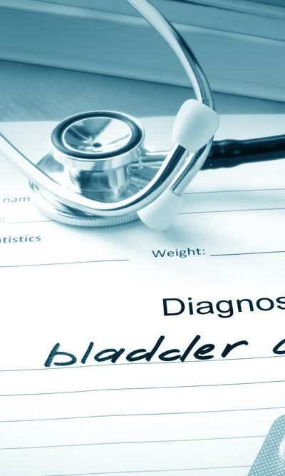 The Common Causes of Bladder Cancer