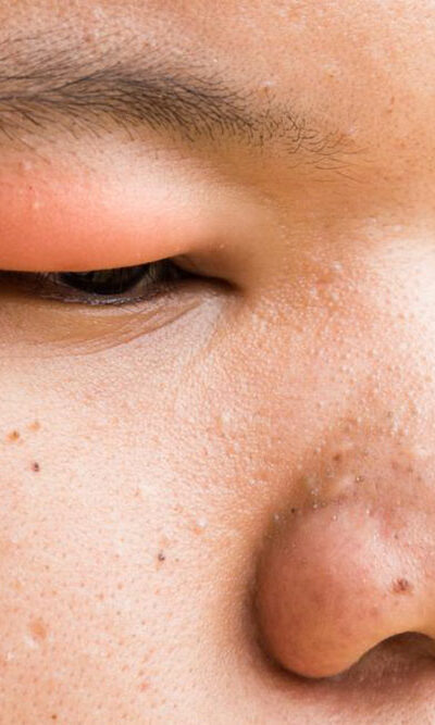 These are the causes of stye that you need to be aware of