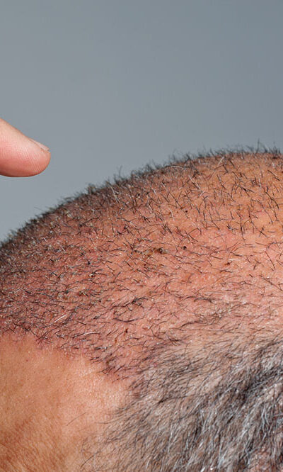 The truth about how much hair transplants cost