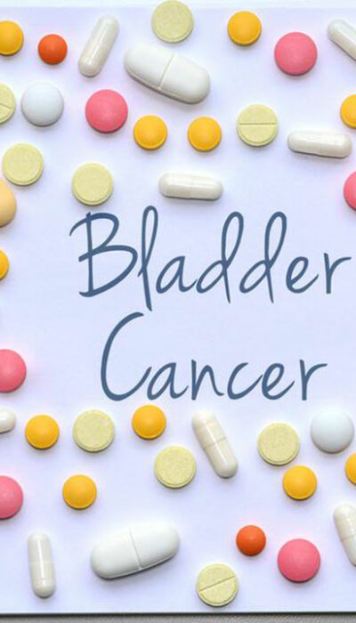 Things to know about the different stages of bladder cancer