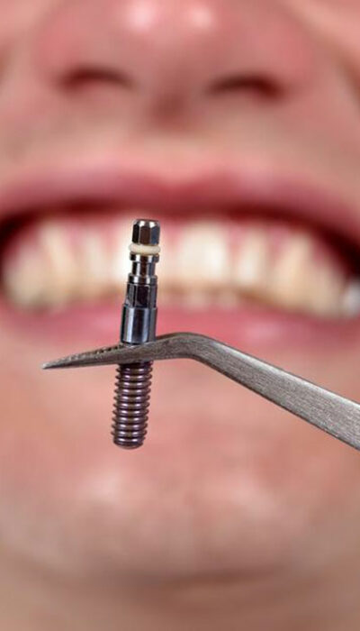 Things you should know about dental implants costs