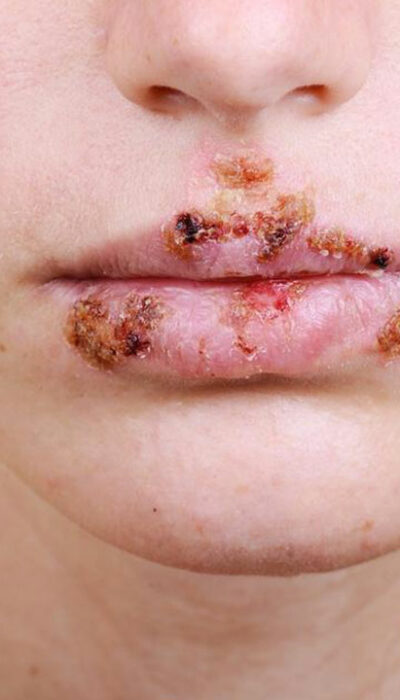 Tips to manage herpes outbreak