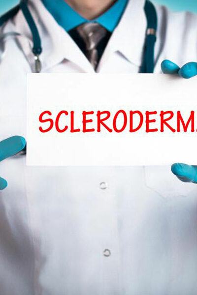 Treating the early symptoms of scleroderma