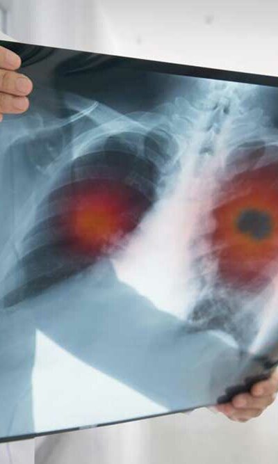 Understanding the Various Pulmonary Fibrosis Treatment Methods