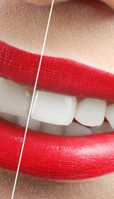 Yellow Teeth &#8211; How to avoid discoloration of teeth