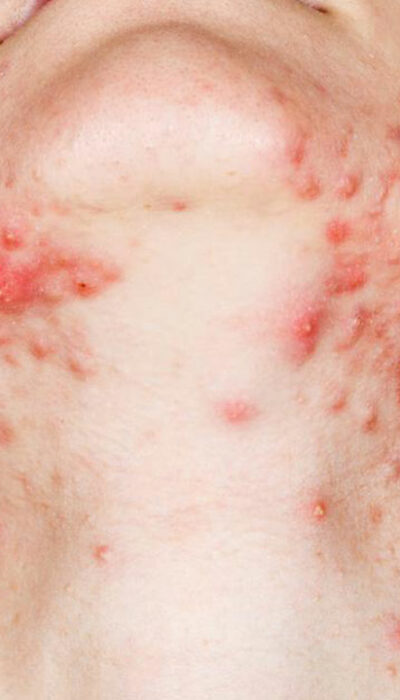 10 Effective Home Remedies to Cure Shingles