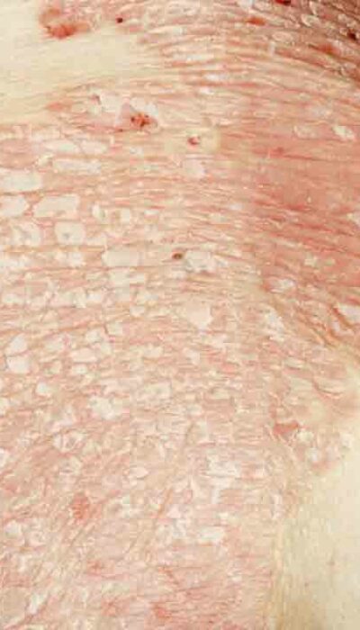 7 Common Types of Eczema