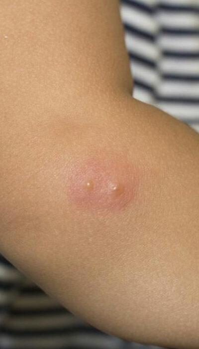 4 Popular Creams for Alleviating Shingles Pain