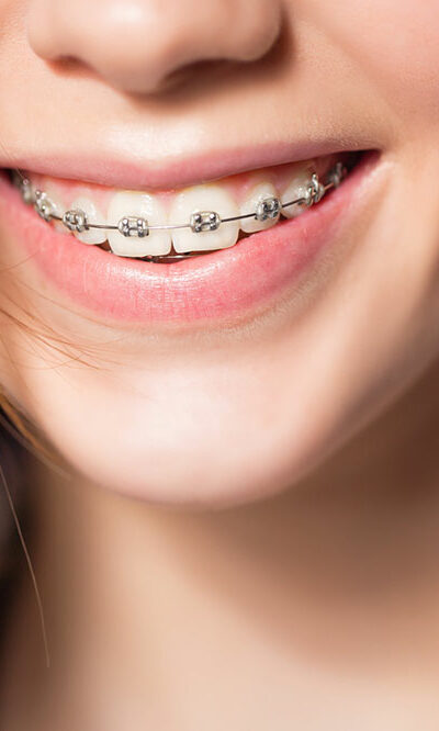 4 common types of teeth braces for adults