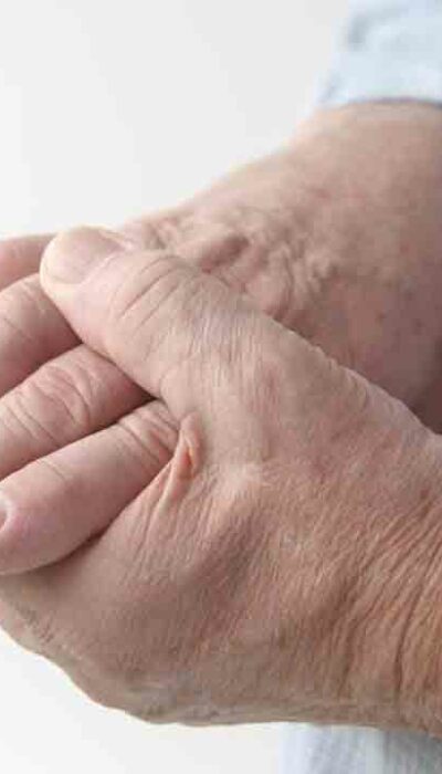 5 Best Gout Treatments