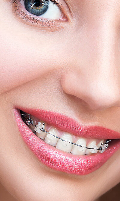 5 things you should know before you get braces