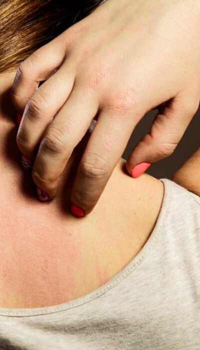 6 Natural Ways for Instant Relief from Itchy Skin