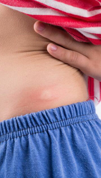 6 Daily Activities That Help In Shingles Rash Treatment