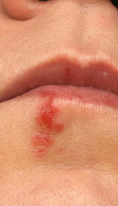 6 Effective Remedies for Treating Cold Sores