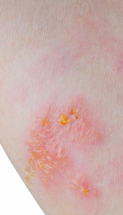 6 Home Remedies for Treating Skin Rashes