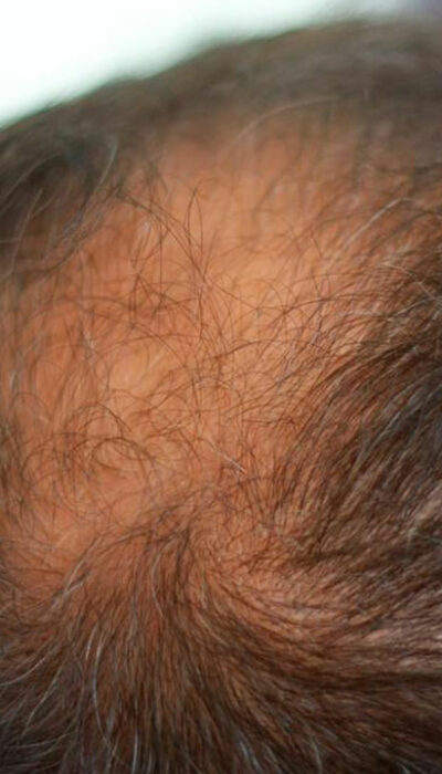 8 Effective Home Remedies for Thinning Hair