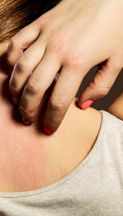 8 Simple Tips to Treat an Eczema Rash