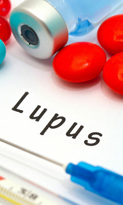 9 Early Signs and Symptoms of Lupus