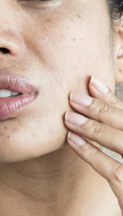 9 Symptoms of Lupus Women Should Know About