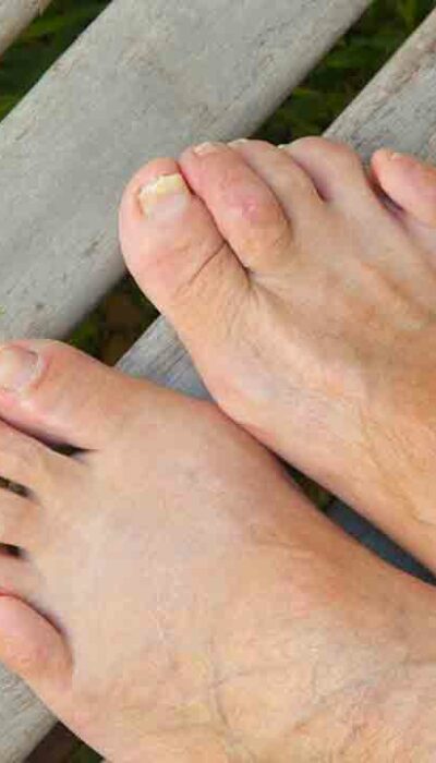 9 Simple Home Remedies to Cure Toenail Fungus