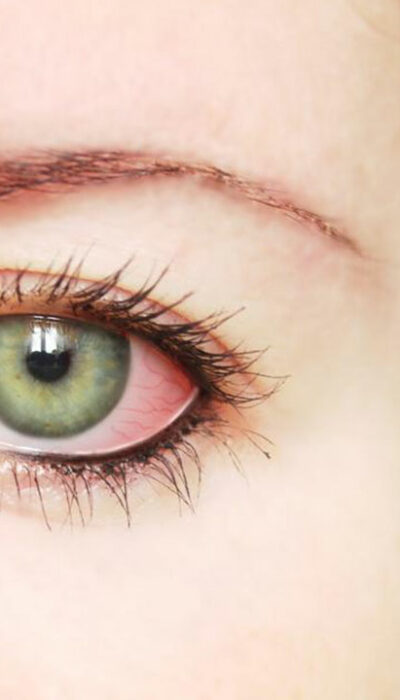 Common Causes and Treatments for Red Eye