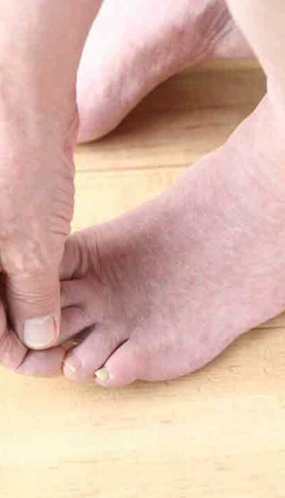 Common Diabetic Feet problems and Its Preventive Measures