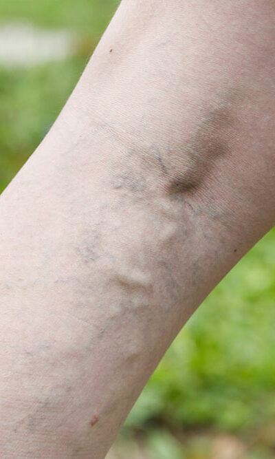 Common Symptoms and Treatments for Varicose Veins