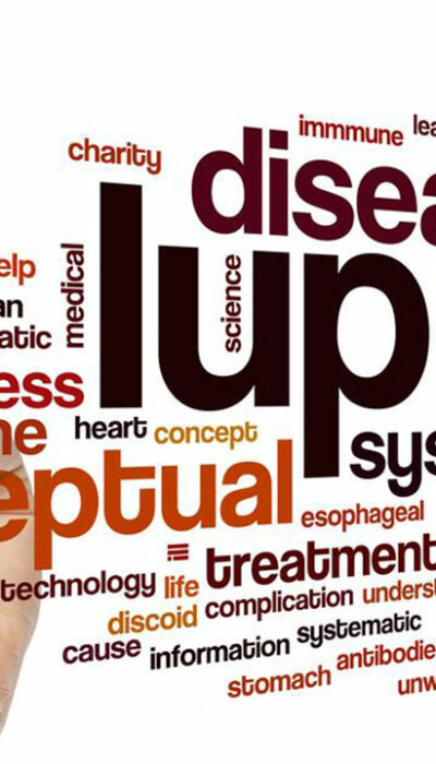 Common Symptoms of Lupus in Women