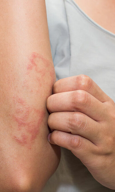 Common Types and Treatments of Eczematous Dermatitis