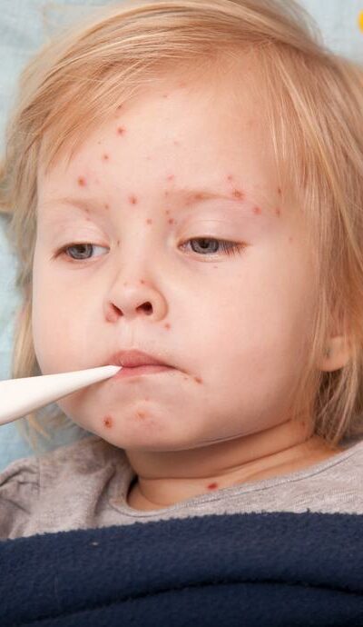 Causes, Symptoms, and Treatment of Measles