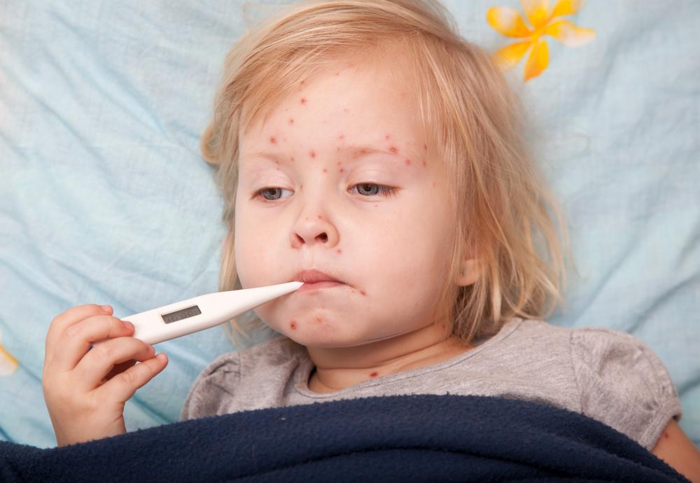 Causes, Symptoms, and Treatment of Measles